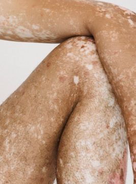 Small White Spots on Arms and Legs: Common Causes Explained