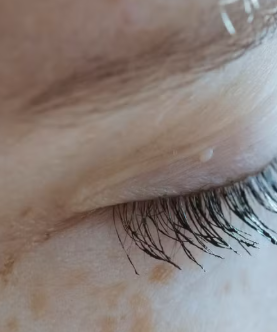 Tiny White Bumps on Eyelids: Common Causes and What They May Mean