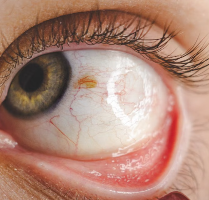 What Is a Pinguecula? Early Signs, Causes, and Treatment